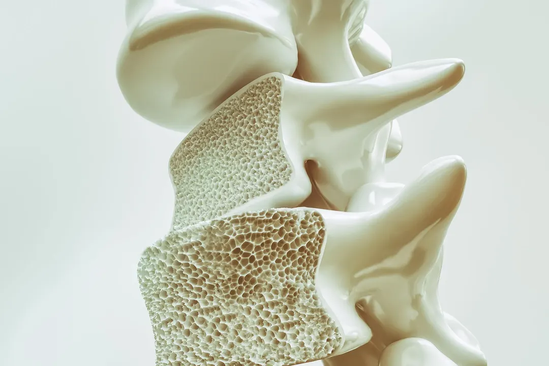 Study Links Bone Density to Faster Brain Aging