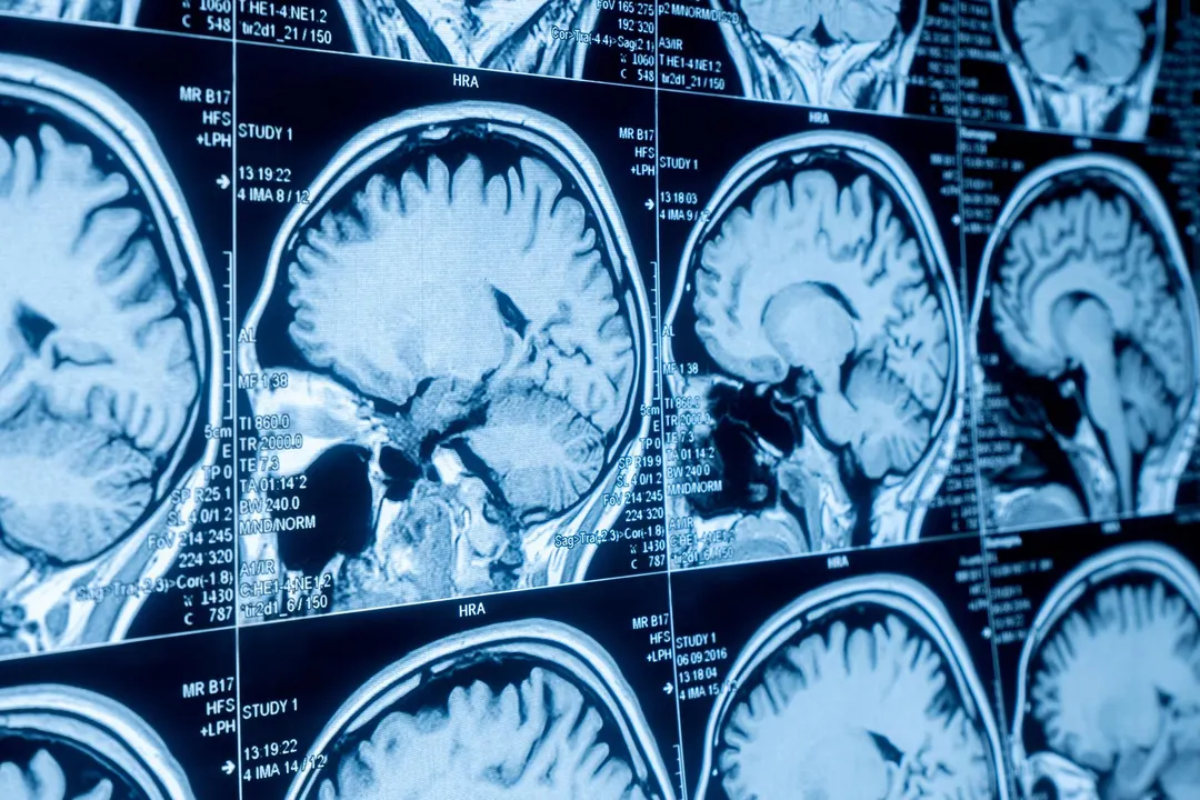Scientists Link Brain Aging to Gut Microbiome Patterns
