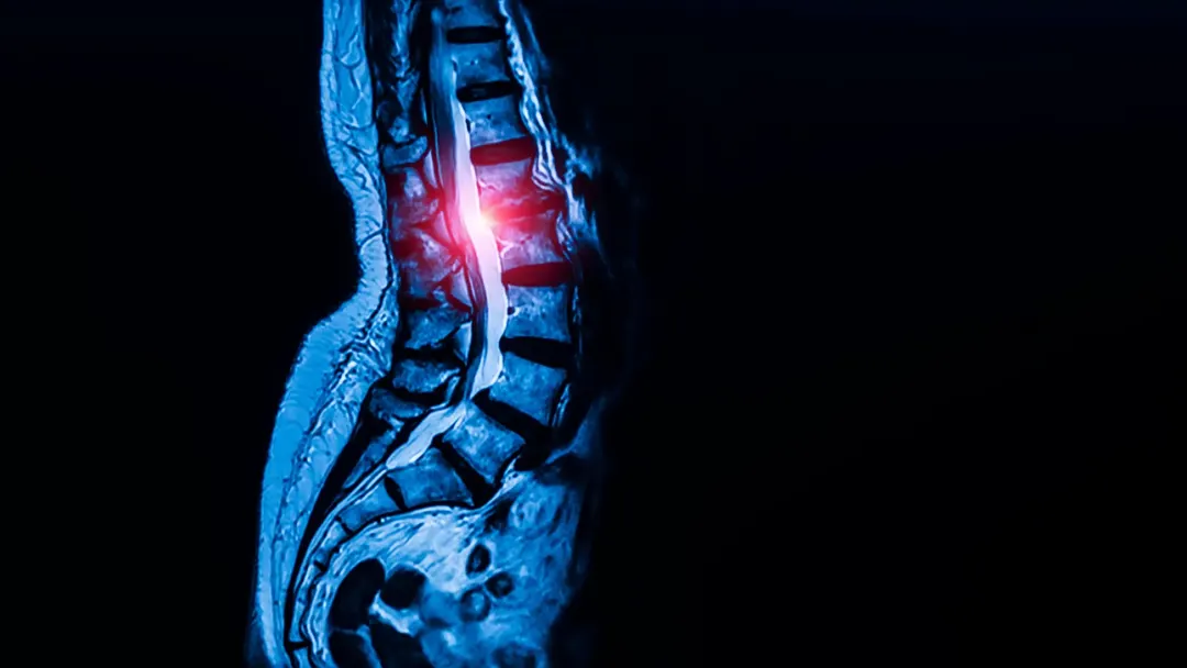 Stem cells behind tendons and ligaments linked to spinal stenosis