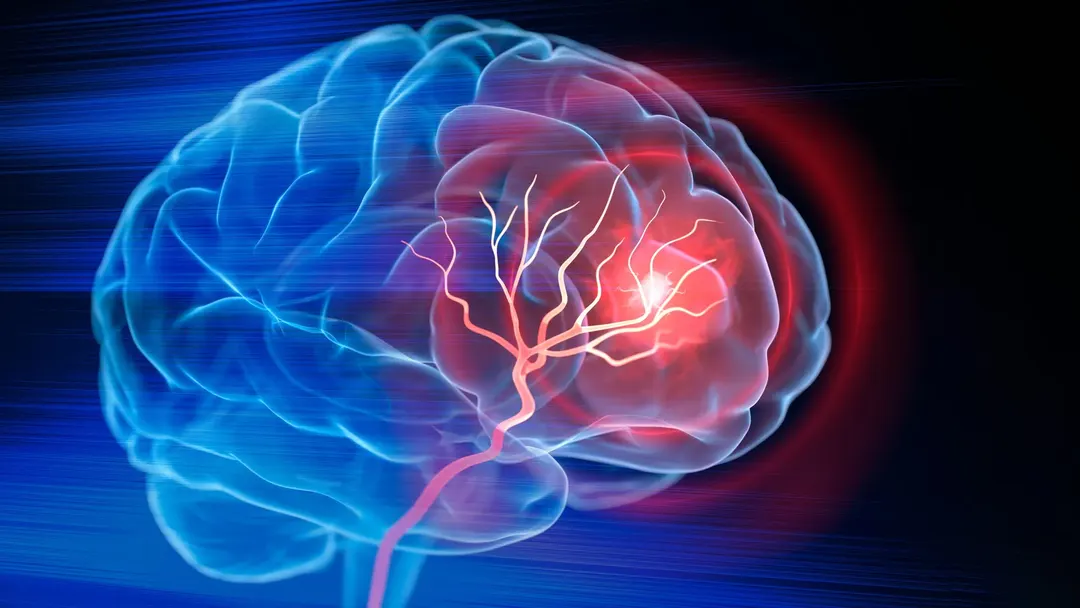 Alzheimer's risk gene APOE4 damages brain vessels, but damage may be reversible