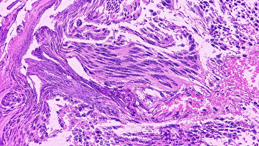 Stanford Urine Test Detected 95% of Bladder Cancer Cases