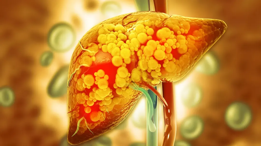UBE2N enzyme protects liver as fatty liver disease worsens