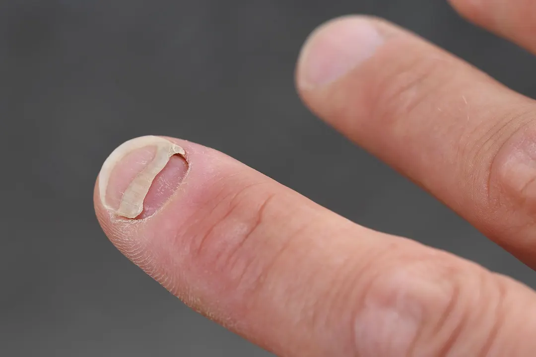 GLP-1 Drugs Linked to Nail and Hair Side Effects