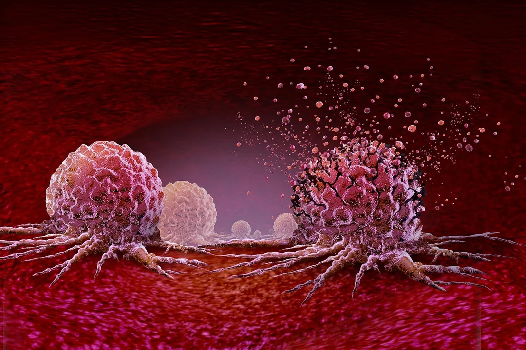 Histotripsy Is Safe, but 11% of Patients Died Within a Month