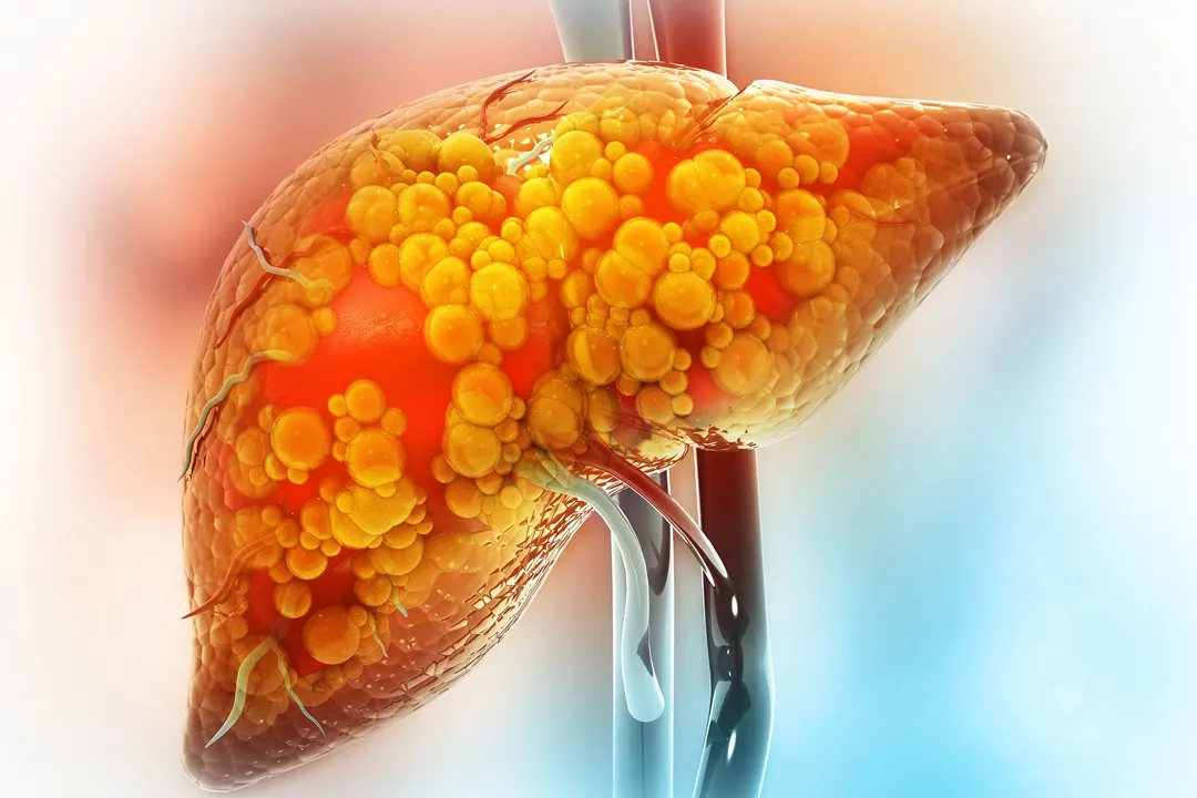 Scientists Identify 5 Hidden Subtypes of Liver Disease Affecting 30% of Adults
