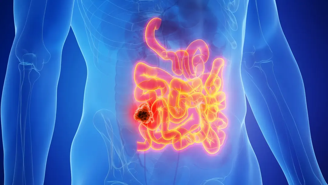 MIT study finds keto diet raises small intestine cancer risk in mice