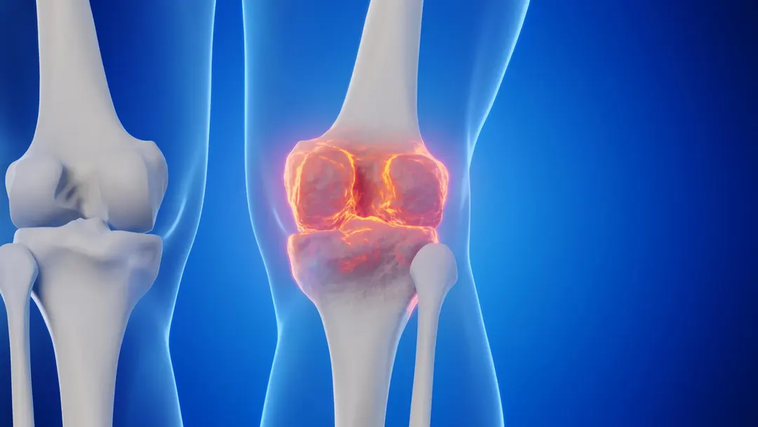 Stanford scientists regrow cartilage and stop arthritis by blocking aging protein