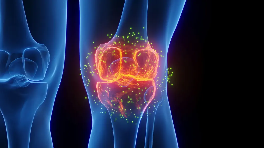 FDA-approved epilepsy drug may reverse osteoarthritis cartilage damage
