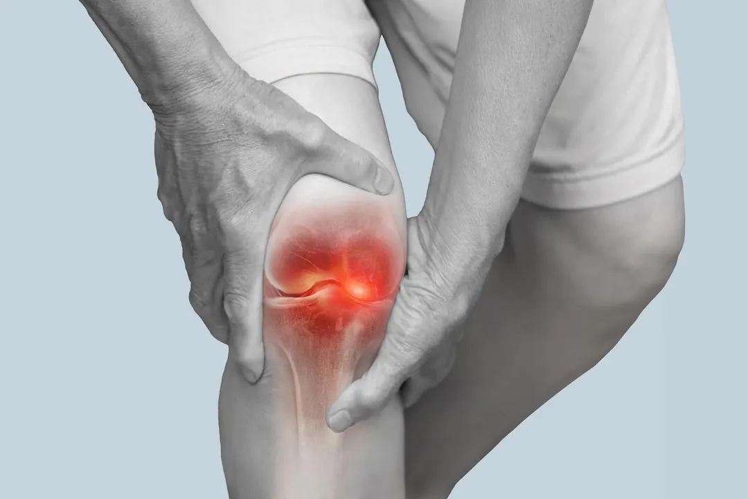 Low-Dose Radiation May Slow Early Knee Osteoarthritis