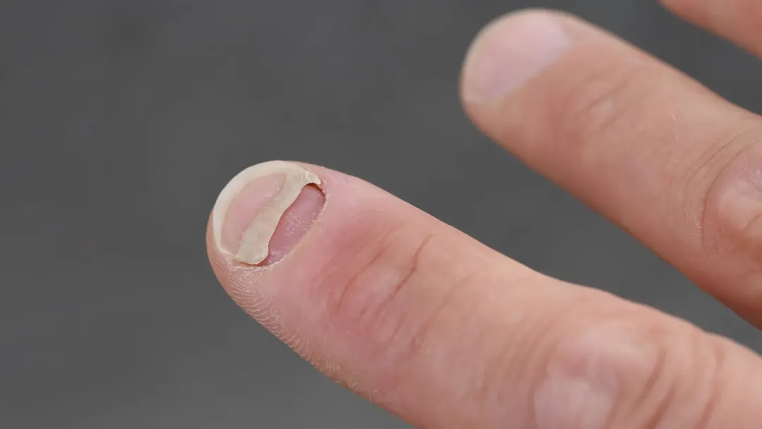 GLP-1 weight loss drugs linked to nail detachment and hair loss