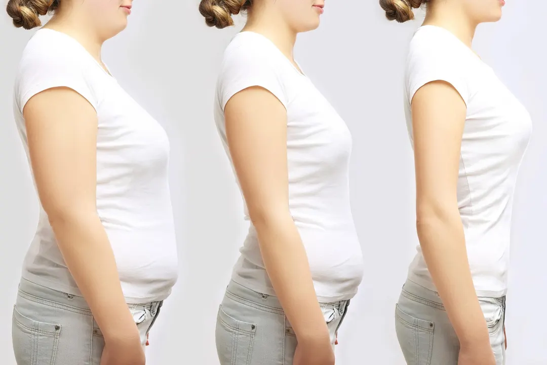 Retatrutide delivers up to 18.8% weight loss in type 2 diabetes trial