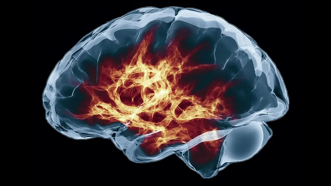 FDA approves Zanvastro, first drug for Alexander disease