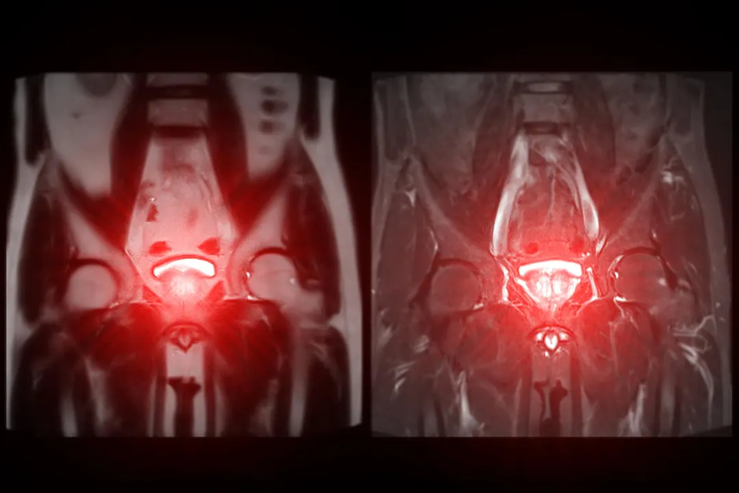 A single tRNA restores drug sensitivity in resistant prostate cancer
