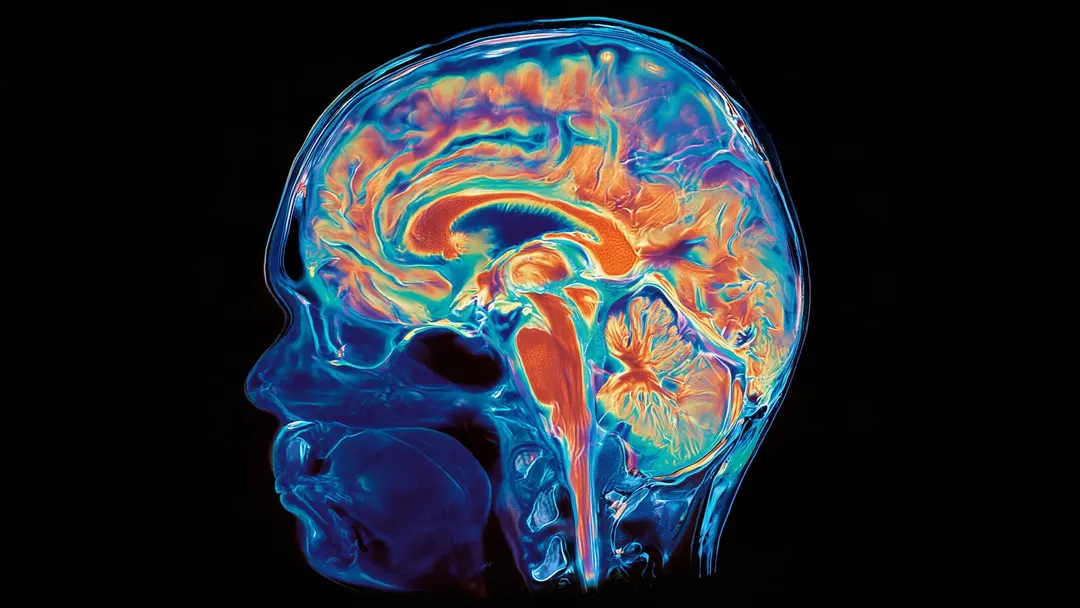 Rare brain study finds sharp divide between amyloid-cleared and untreated regions