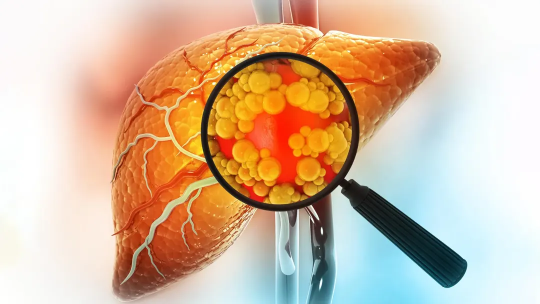 Mayo Clinic scientists identify five distinct forms of fatty liver disease