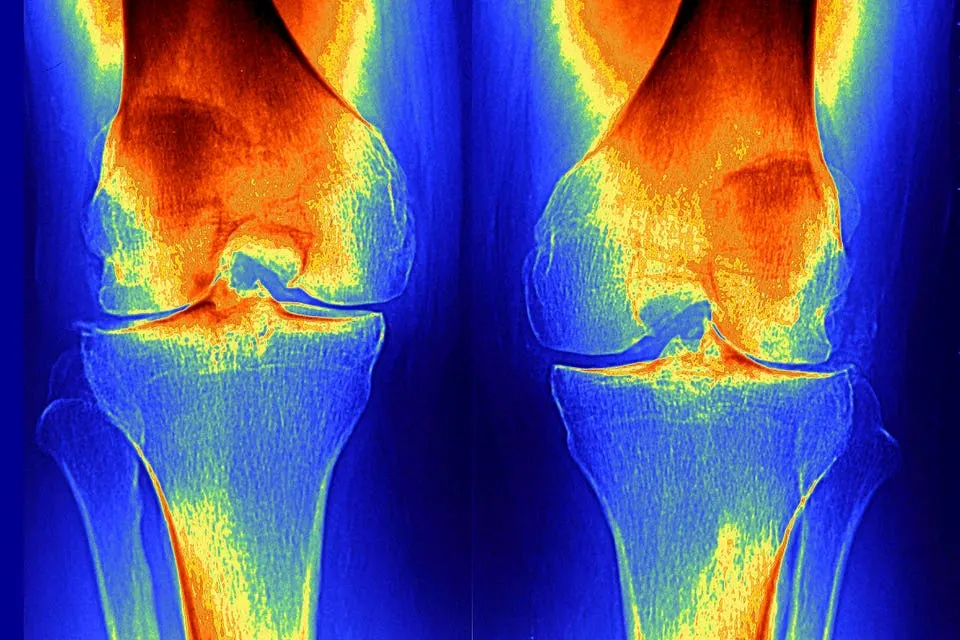 Biotech regrew knee cartilage in mice and starts clinical trials