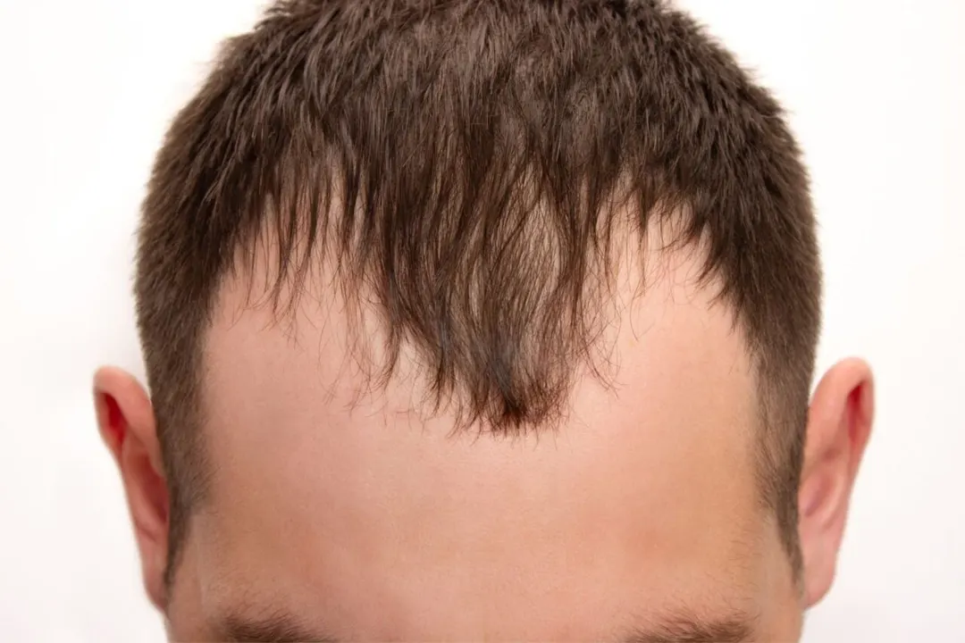 Veradermics' VDPHL01 hair loss pill aces Phase III trial