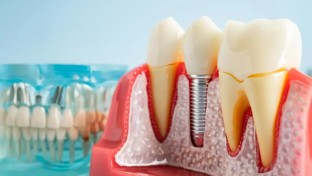 Scientists find how titanium particles from dental implants hijack immunity