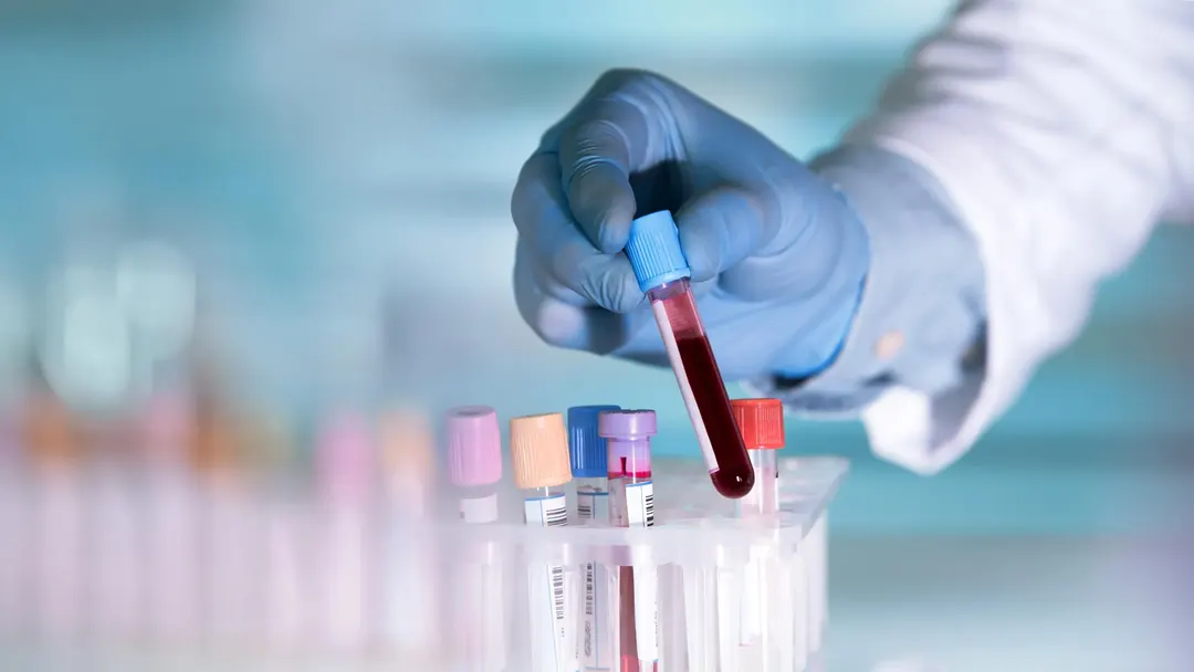 Blood antibody changes appear 10 years before IBD diagnosis