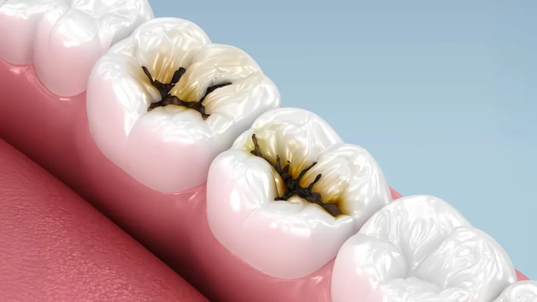 Major trial confirms silver diamine fluoride stops cavities in young children