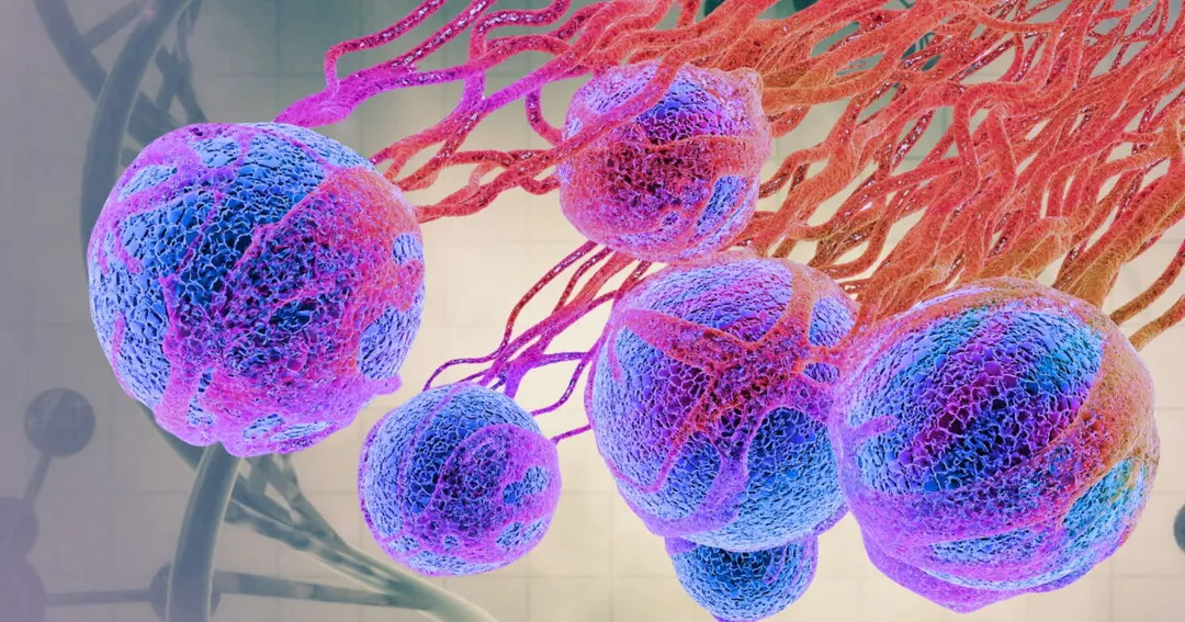 Moderna and Merck melanoma vaccine cuts recurrence risk by 42%