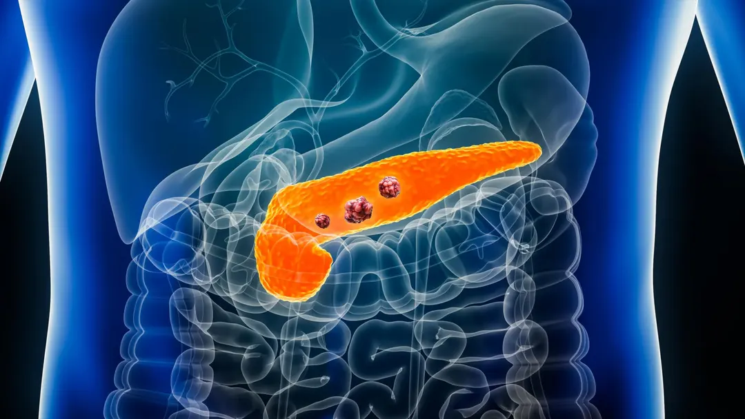 AI model REDMOD detects pancreatic cancer signs 475 days before diagnosis